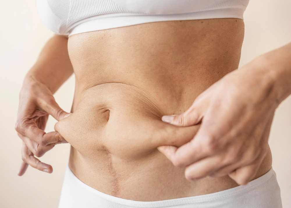 Tummy Tuck Without Liposuction results