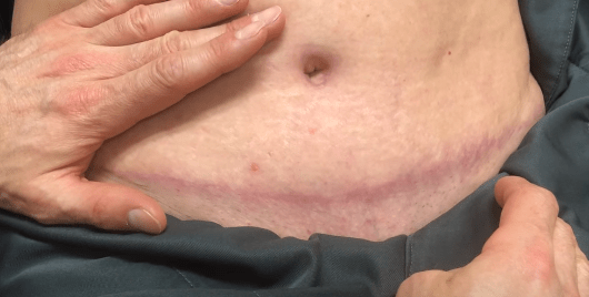 Burning Sensation 3 Months After Liposuction